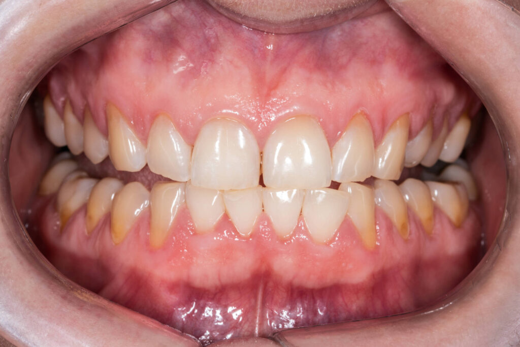 conheca-os-habitos-que-podem-estar-por-tras-da-erosao-dentaria